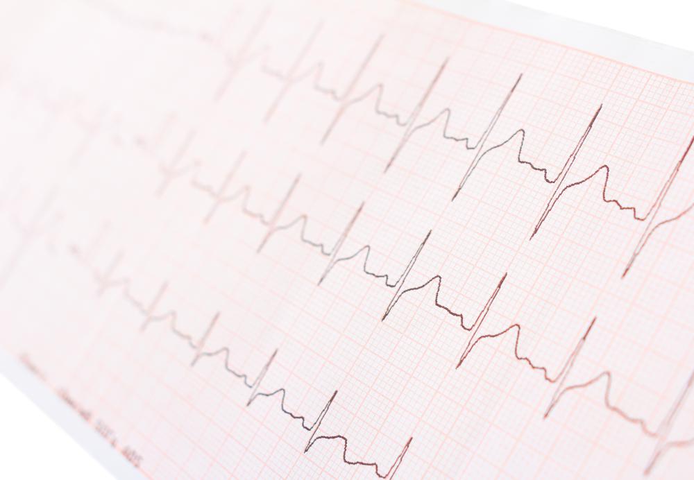 The recordings of an ECG or EKG test.