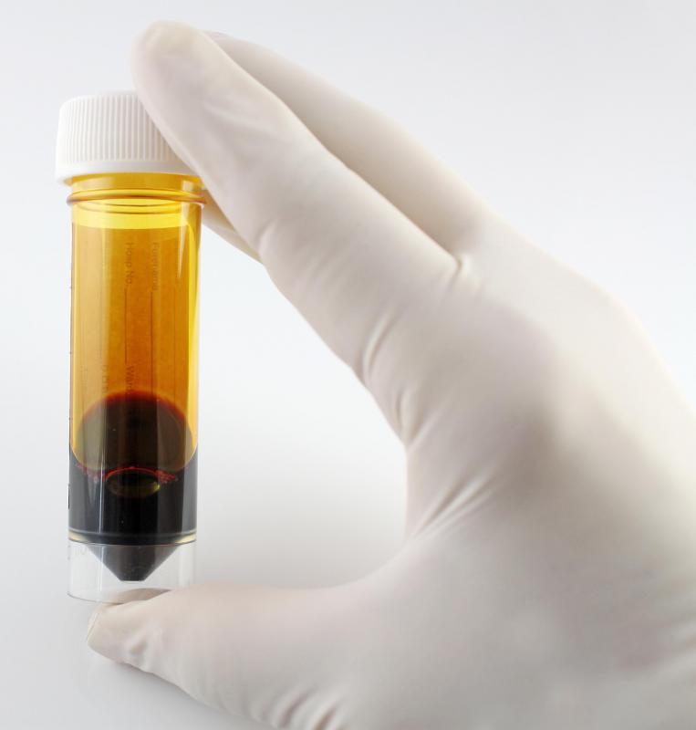 Iodine can be used to prevent infection when removing an ingrown toenail.