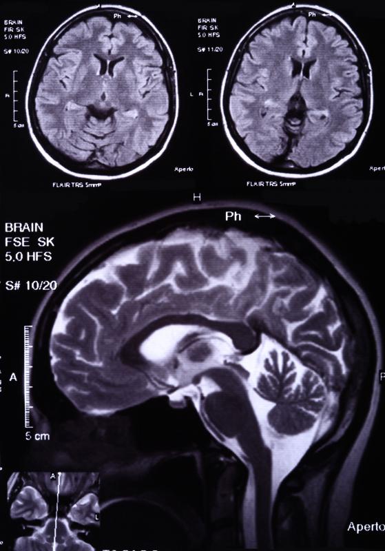 Axons of nerve cells and the fatty material myelin make up white matter.