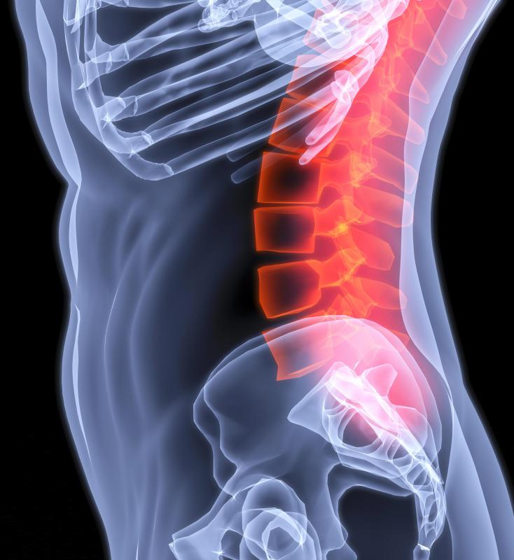 Spinal stenosis can negatively affect the functioning of a person's body.