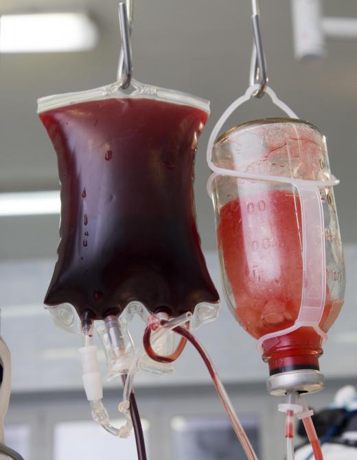 A person with severe anemia may need a blood transfusion.