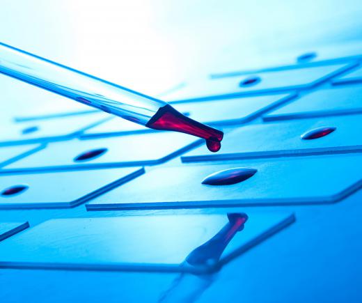 Leukemia may be diagnosed by analyzing blood samples.