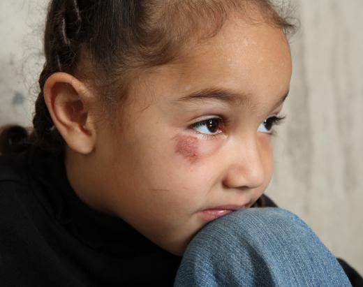 Child psychologists may work with children who have been abused.