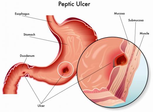 A peptic ulcer may develop if too much acid exists in the stomach.