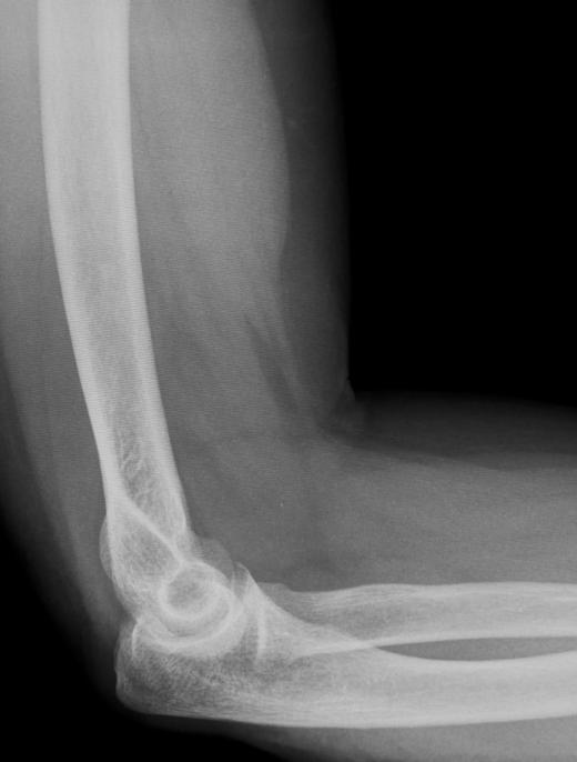 An X-ray of the elbow may be performed to determine the reason for ulnar nerve pain.