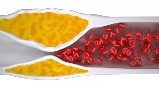 The artery-constricting and plaque-inducing effects of neuropeptide Y may partially explain the common link between obesity and coronary artery disease.