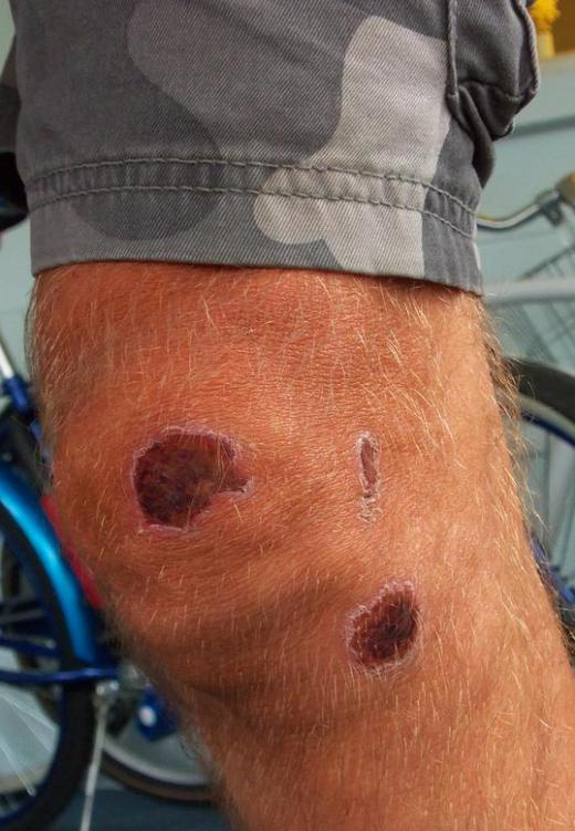 Scabs form during the epitheliation stage of wound healing.