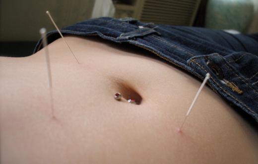 Treatment for a barometric pressure headache may include acupuncture.