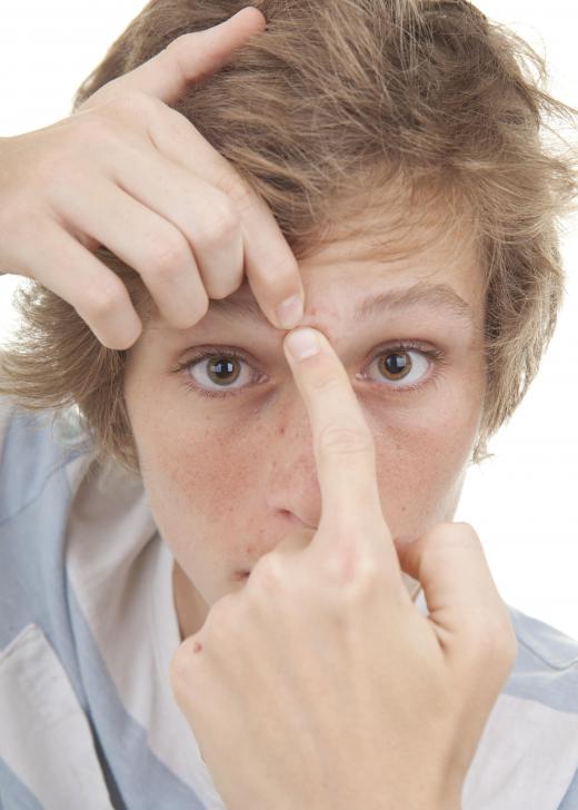 Popping pimples can lead to infection and cause scarring.