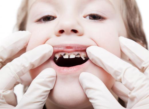 Tooth decay may cause a tooth nerve to become inflamed.