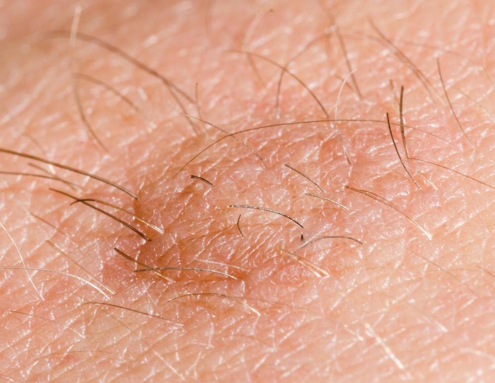A soft fibroma can form on areas where skin rubs together.