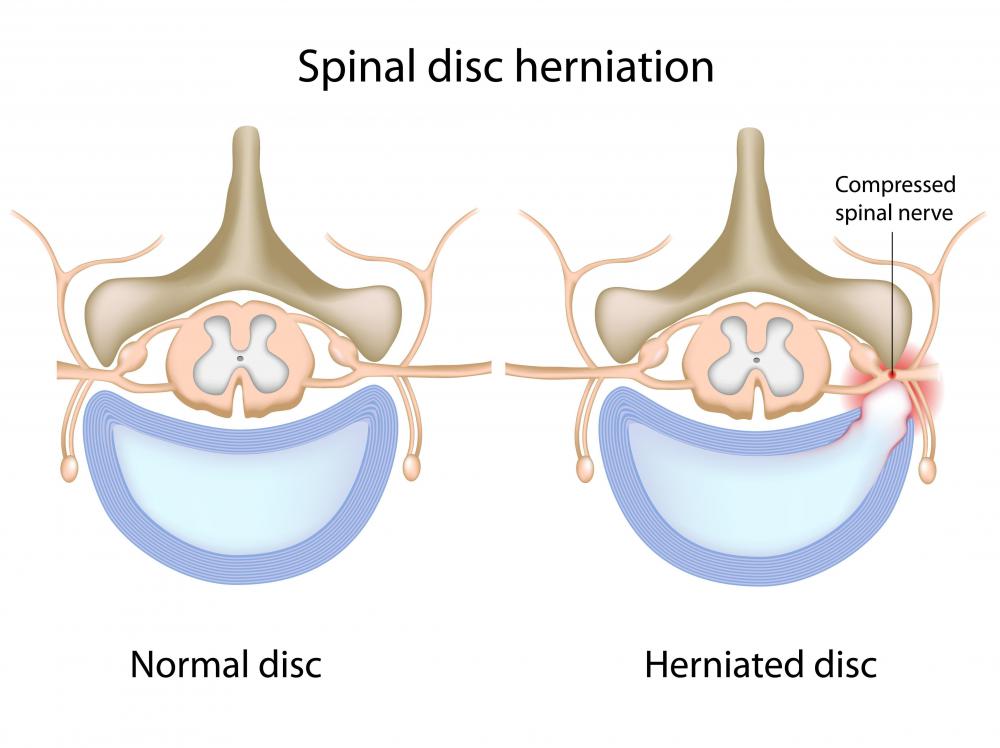 A healthy spine and a spine with a herniated disc.