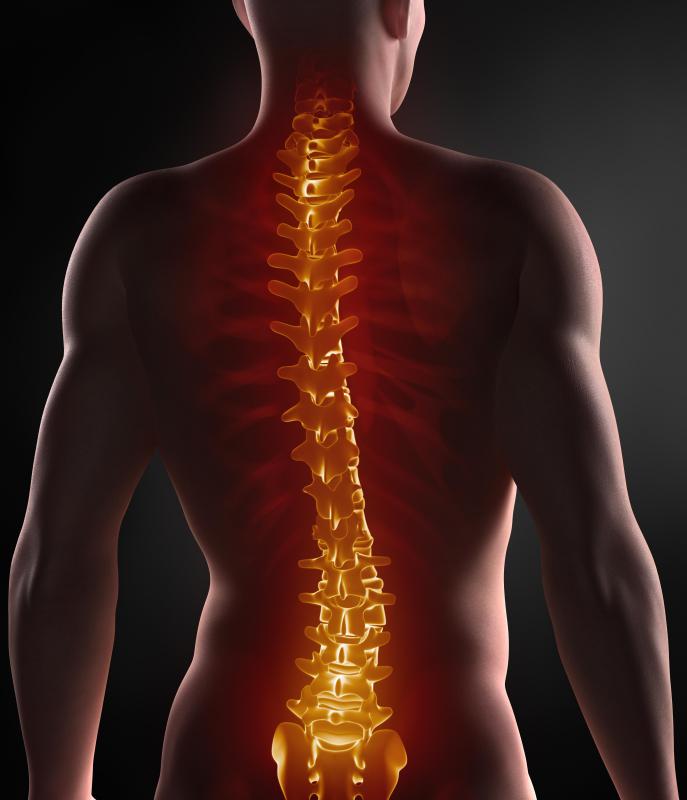 A type of spinal stenosis may occur because of posterior osteophytes.