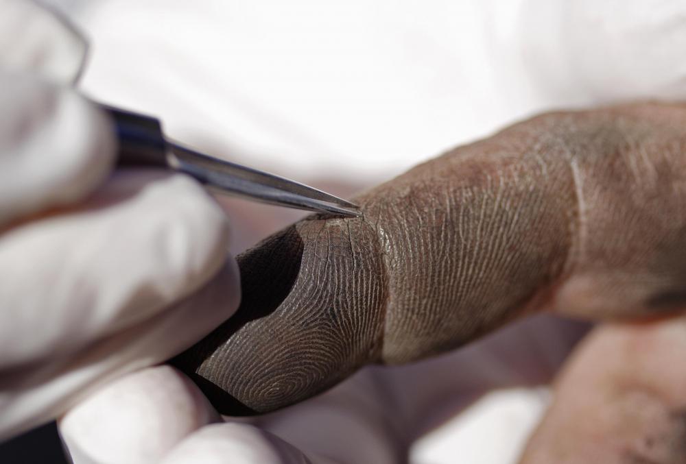 Drawing ointments can help pull small splinters lodged beneath the skin.