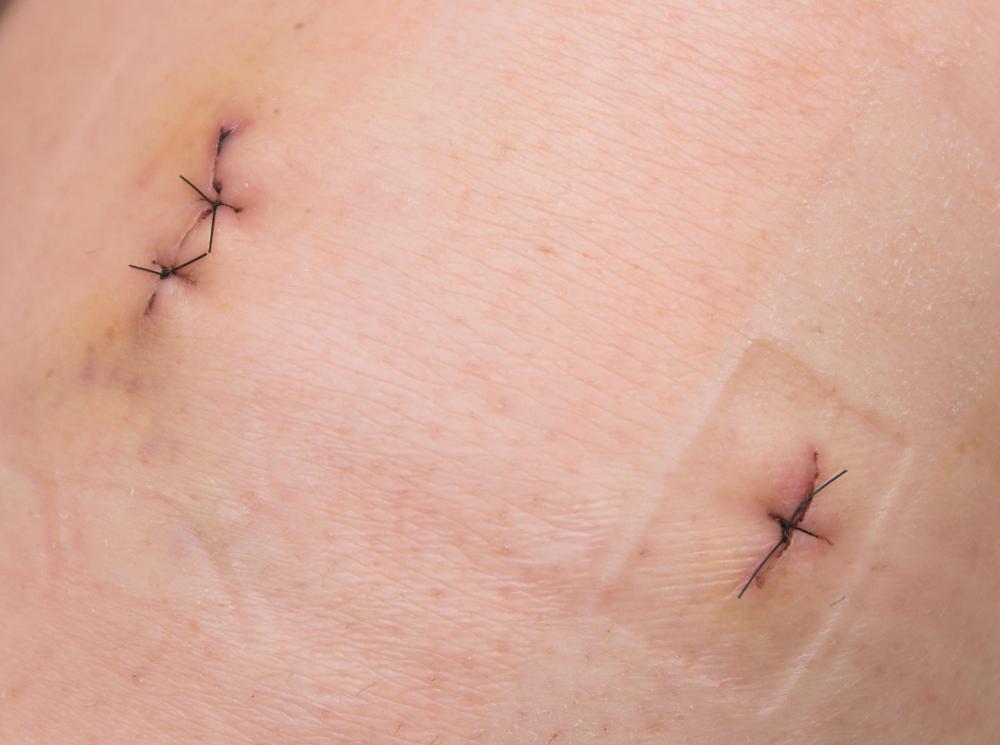 With an interrupted suture, the stitches will not be connected to one another.