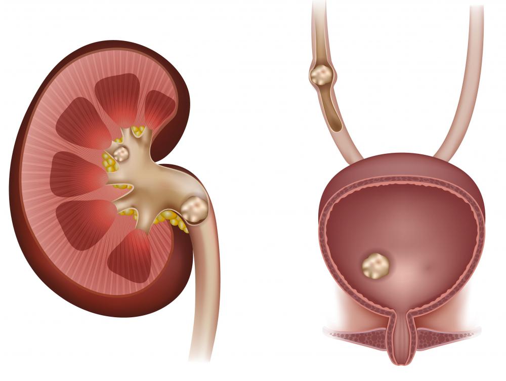 People with kidney stones should use dicalcium phosphate with caution, due to its fairly high concentration of calcium.