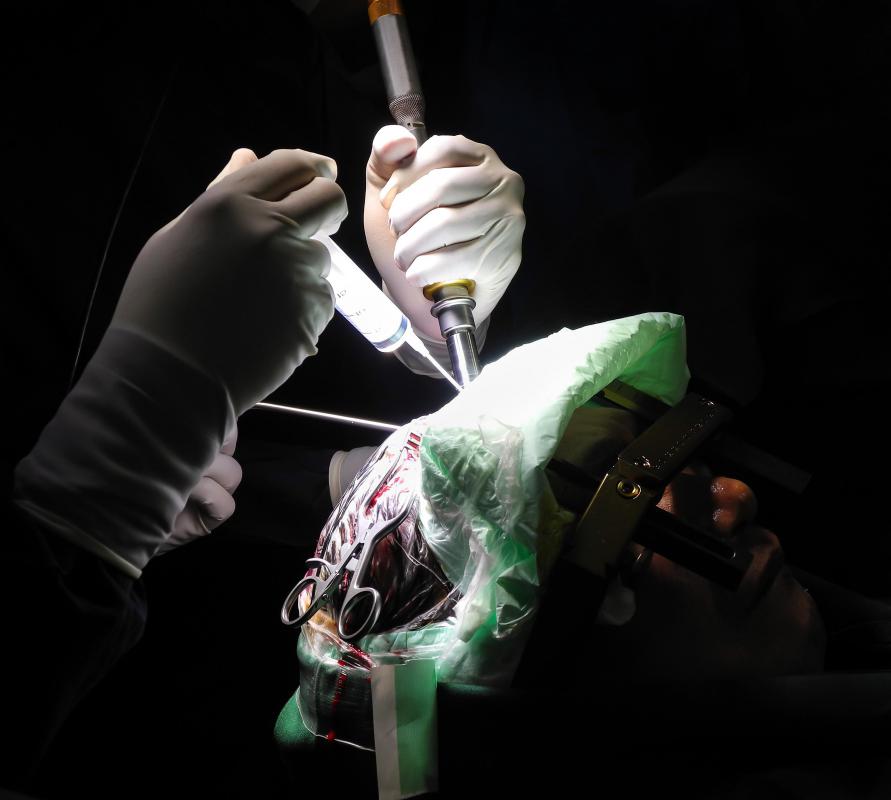 Cortical blindness may occur following brain surgery.