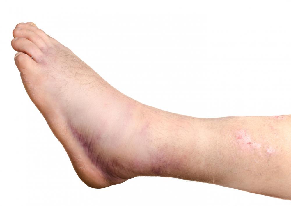 A swollen leg can be caused by a variety of ailments, some of them very dangerous.