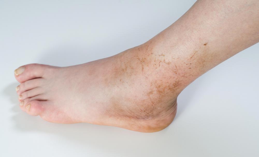 A buildup of fluid in the ankle joint is referred to as an ankle effusion.