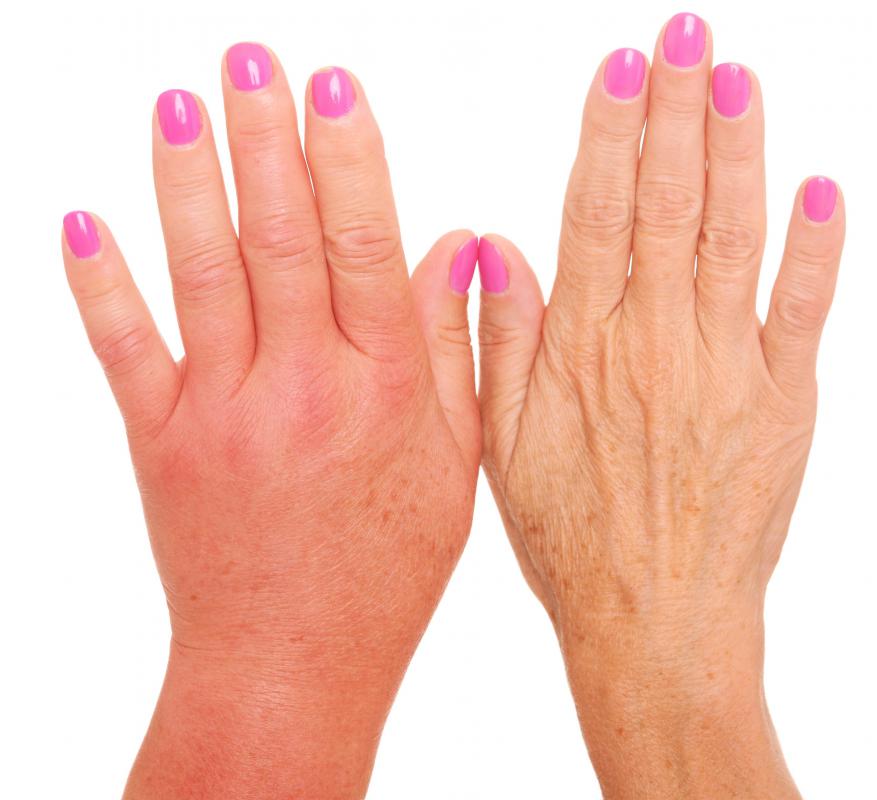 A bruised hand may produce pain and swelling.