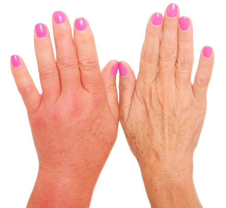 An infection may cause red fingers and swollen hands.