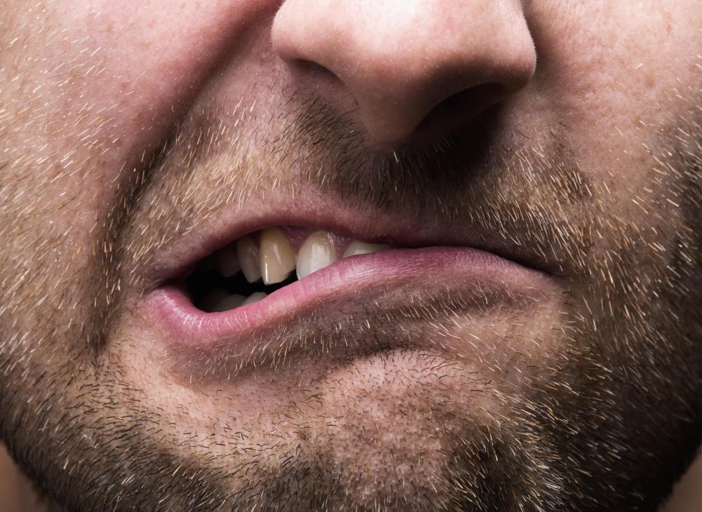 Teeth grinding may cause cracked teeth.