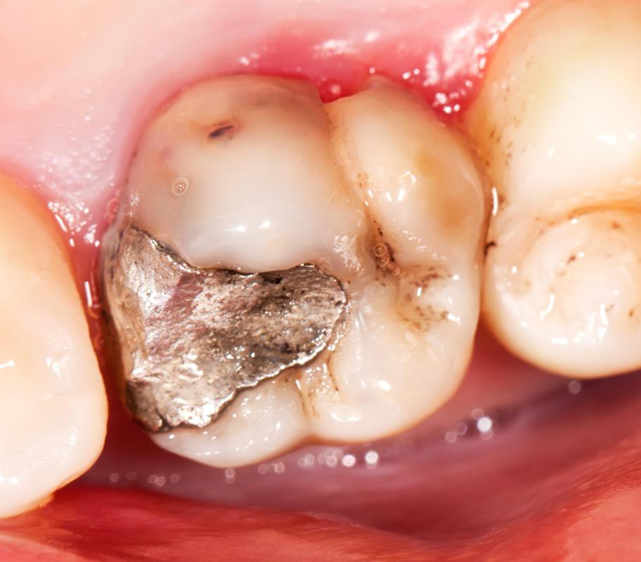 Silver amalgam is a popular material for filling decayed teeth.