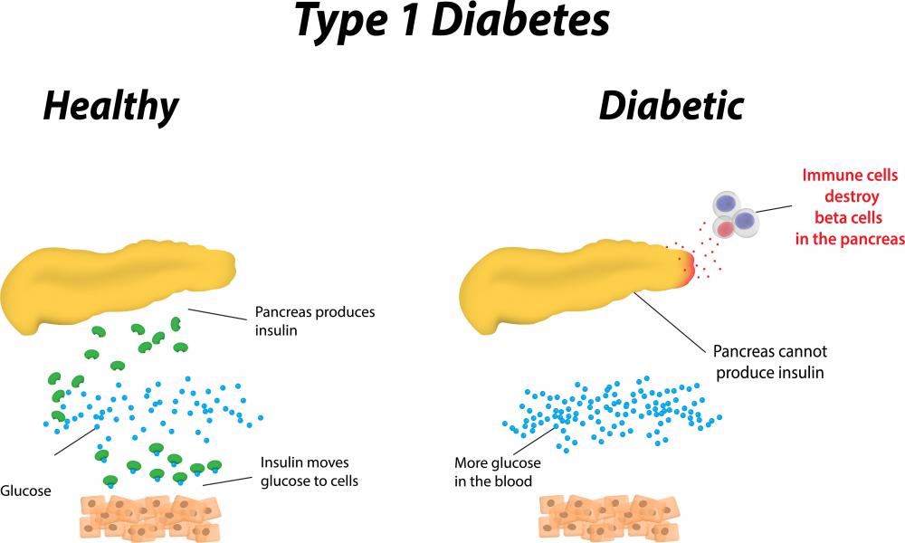 Oxidative metabolism is affected by type 1 diabetes.