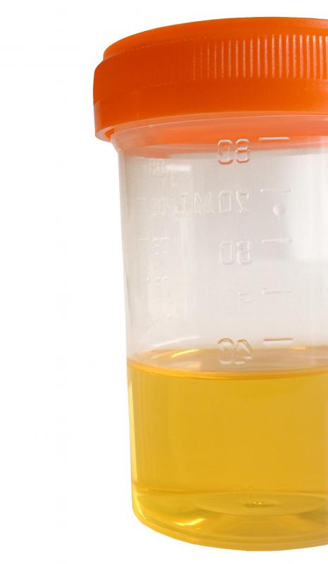 Urine samples may be collected to determine the reasoning behind abnormally elevated levels of catecholamines.