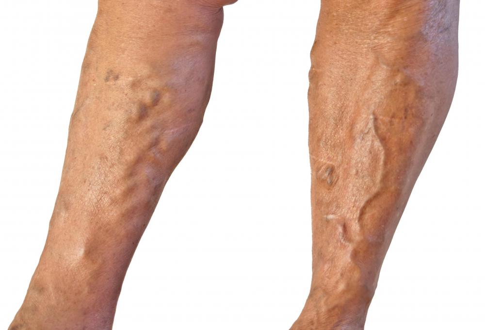 Massage should be avoided where there are varicose veins.