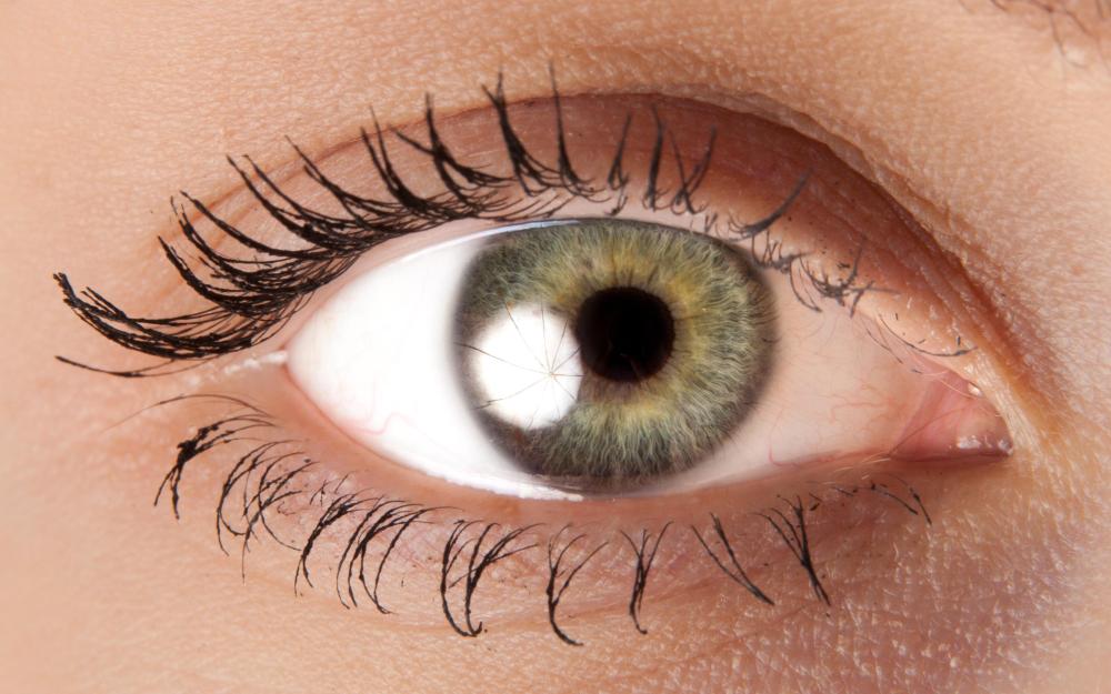 A broken cheekbone may affect the position of a person’s eye.