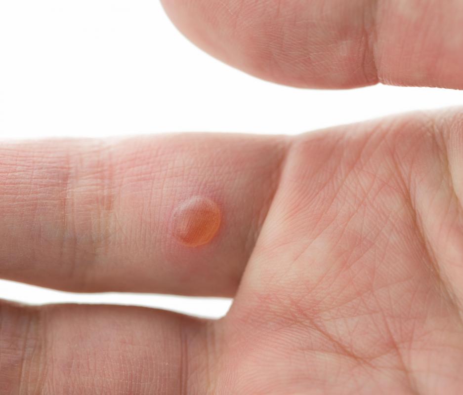 Warts are typically caused by a viral infection.