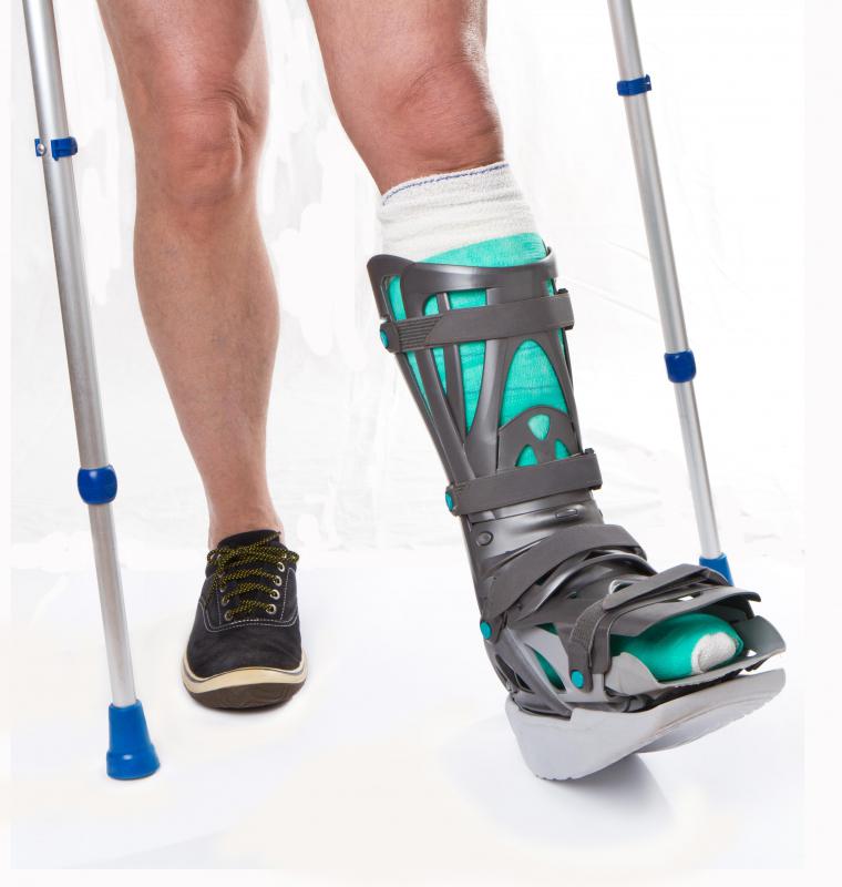 Leg casts and crutches may be needed to stabilize the ankle.
