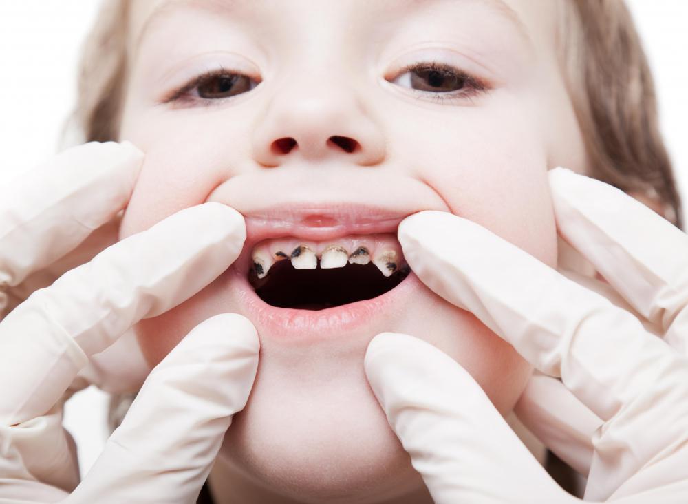Tooth decay may cause inflammation of a tooth nerve.