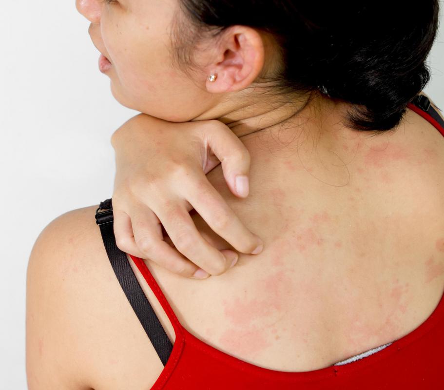Notalgia paresthetica can cause the back to itch.