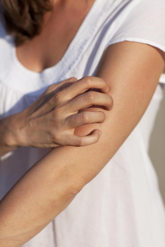 Colloidal oatmeal can be use to treat itchy skin.