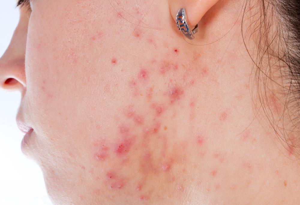 Adolescents with acne may be helped by red light therapy.