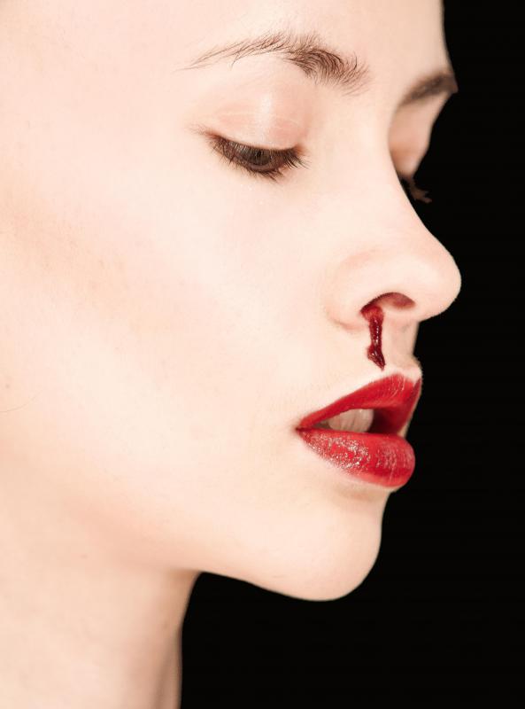 It is important to keep the head elevated for at least 48 hours after nasal septoplasty to limit bleeding and swelling.