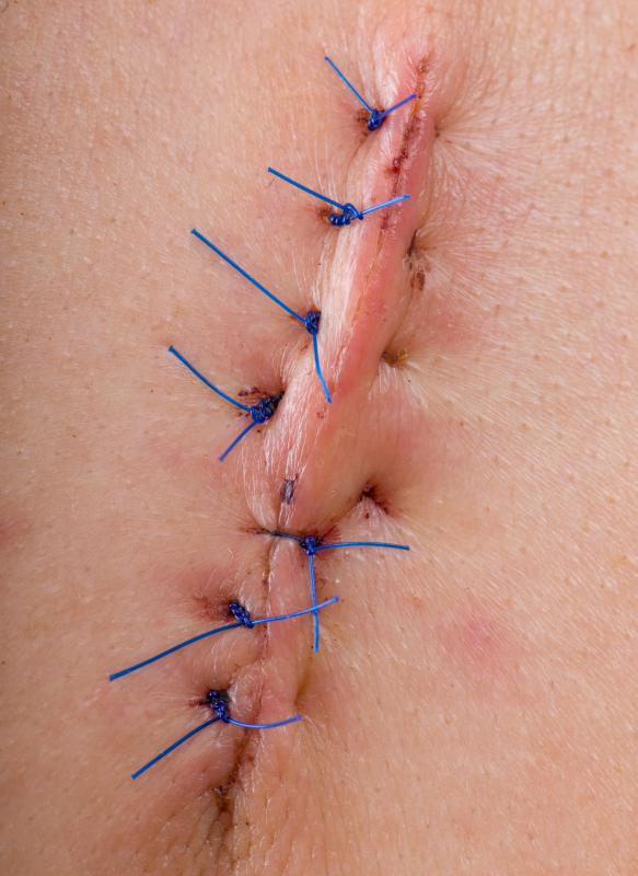 Some wounds require suturing.