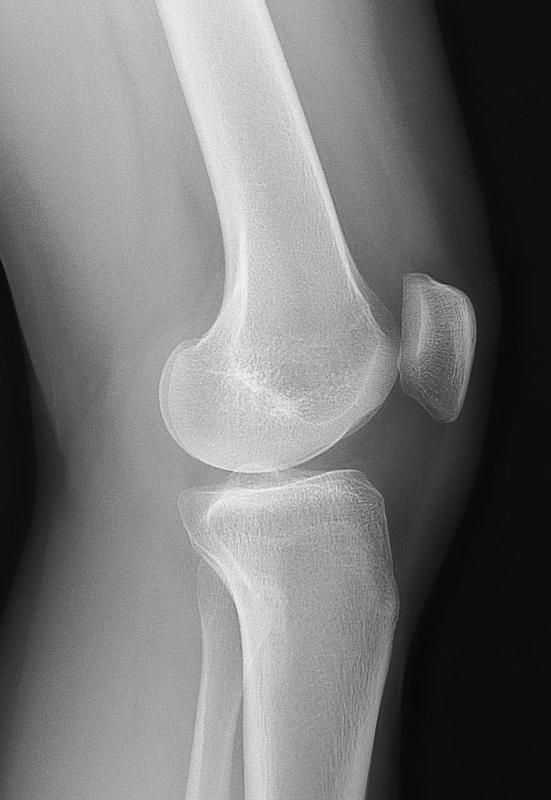X-ray of a human knee, where both the tibia and kneecap can be seen clearly.