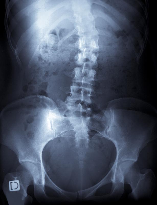 Scoliosis types are determined by the degree of spinal curvature.