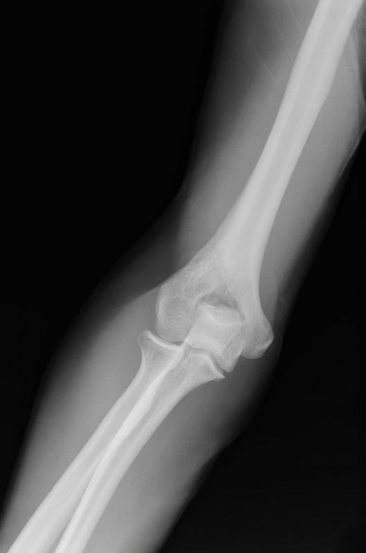 An X-ray may be required to diagnose fractures to the olecranon process.