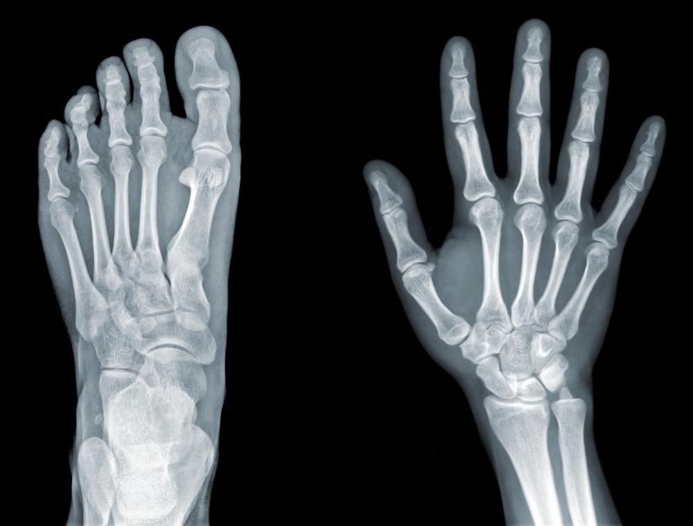The flexor carpi ulnaris connects to the bone at the base of the pinky finger.