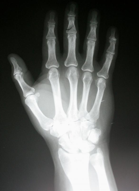An X-ray may be performed to determine the cause of a swollen wrist.