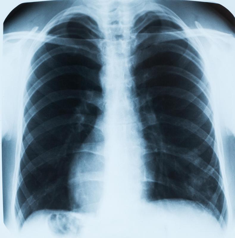Most lung nodules aren't found unless a person has a chest x-ray.