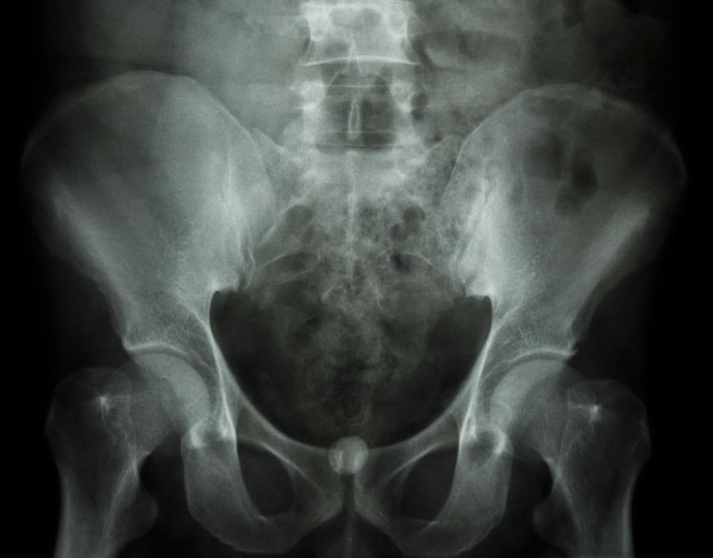 A cystogram involves taking X-rays to examine the bladder.