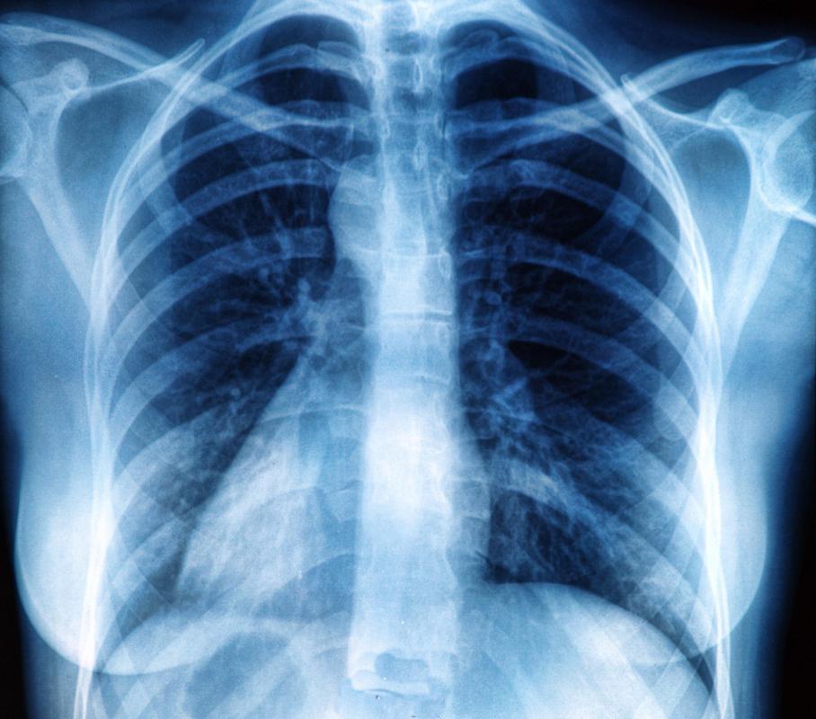 X-ray of rib cage which shows the costophrenic angle.