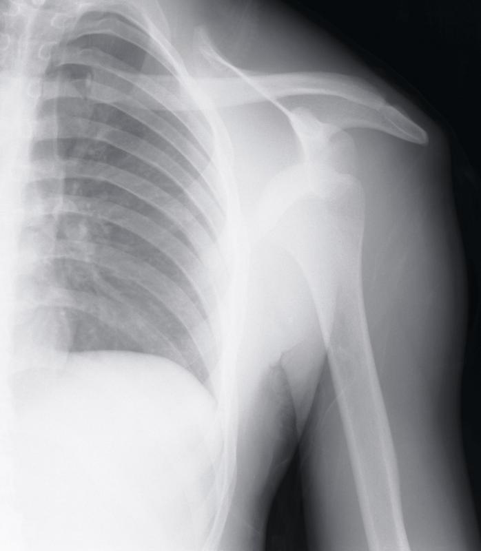 A scapula fracture may be diagnosed with an X-ray.