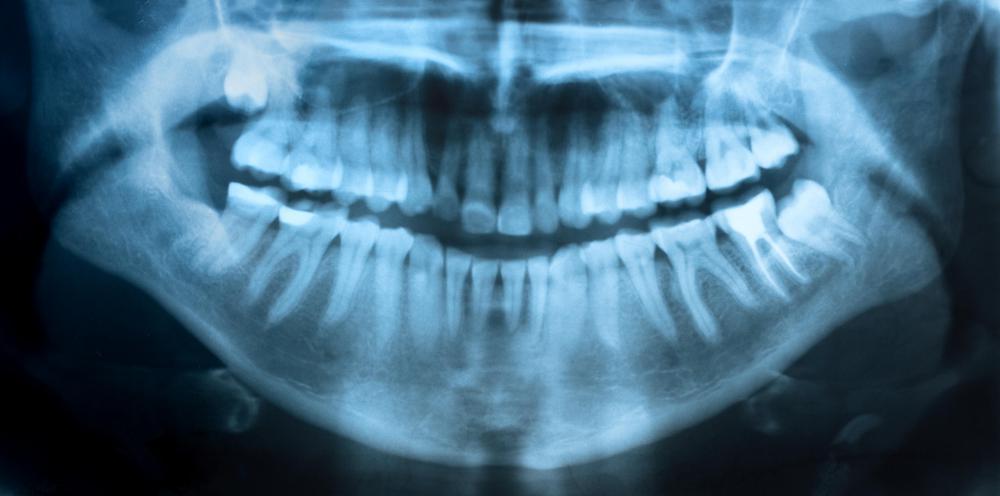 X-rays of the teeth may be taken to diagnose dental resorption.