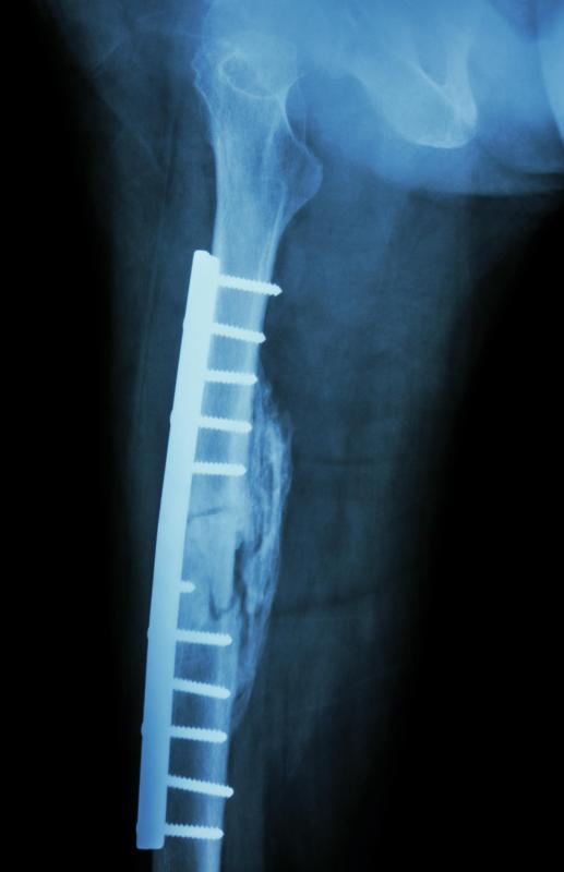 Metal plates and screws can be used to fix a metaphyseal fracture.